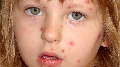 鼻子头上长痘痘怎么办？红霉素对痘痘有用吗？