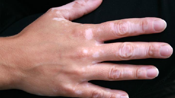 How can I <a href='https://keephealthbest.com' target='_blank'>help</a> in the treatment of vitiligo, and what is the daily care method?