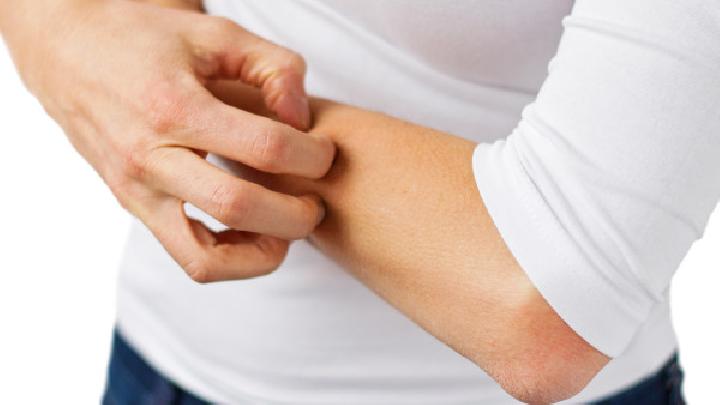 湿疹是什么原因造成的？？