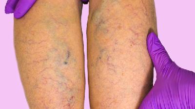 半夜大腳趾痛是得了痛風(fēng)嗎