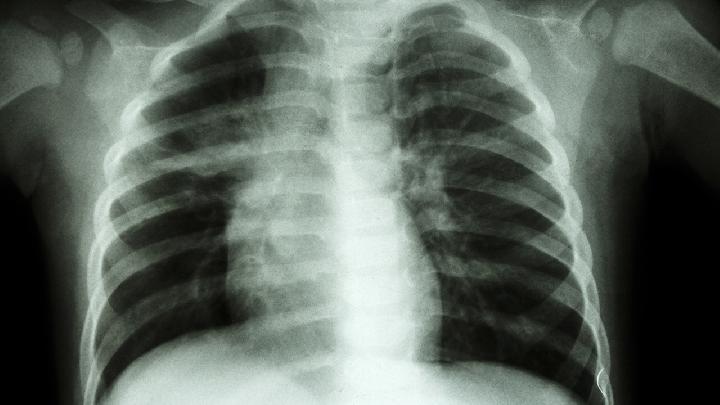 番泻叶减肥方法千万别尝试 番泻叶减肥办法千万别尝试