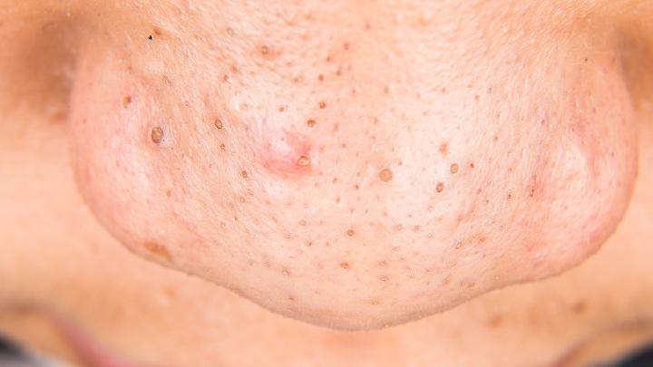 硅胶隆鼻能保持多长时间