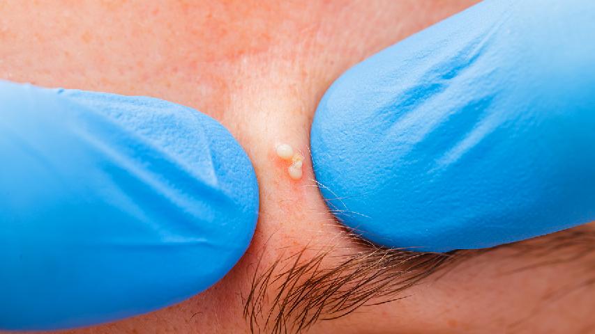 鼻头一直长痘痘是什么原因？鼻头长痘与哪些因素有关？