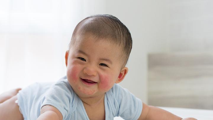 专家介绍婴儿湿疹应该怎么避免？
