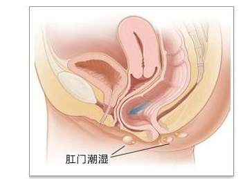 广东民安医院怎样？引起肛周瘙痒的病因是什么？