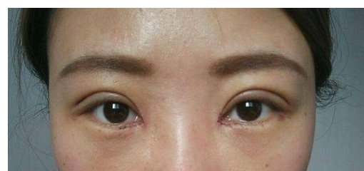 北京好年华：什么样的双眼皮需要修复？