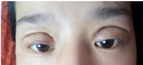 北京好年华：什么样的双眼皮需要修复？