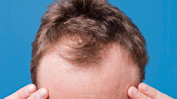 非遗传的脂溢性脱发能治疗吗？