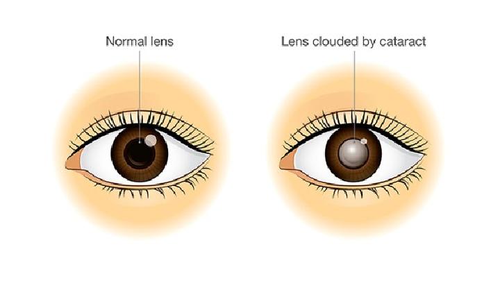 双眼皮疤痕体质怎么办 双眼皮疤痕痒是什么原因