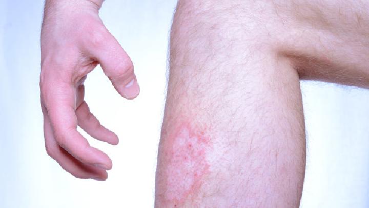 怎样才能根治牛皮癣?-复禾疾病百科