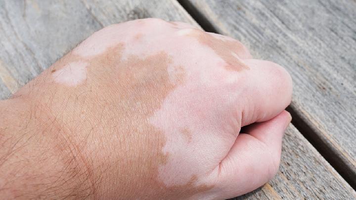 为什么皮肤会出油过多 油性皮肤该如何保养呢