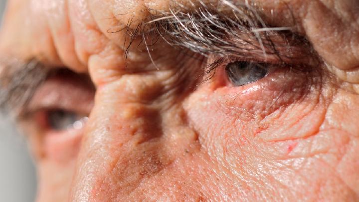 怎样去眼角皱纹抹掉衰老痕迹