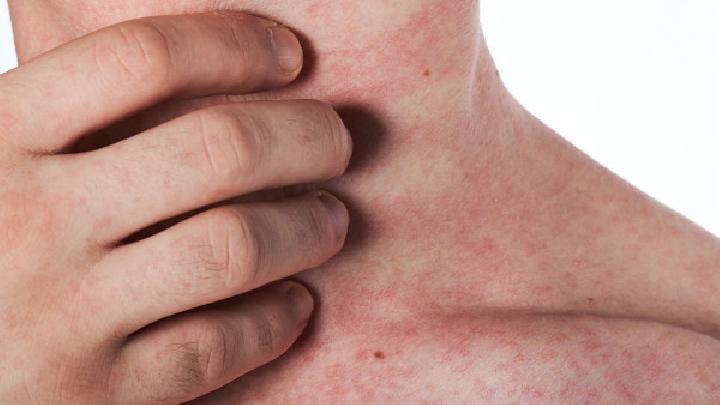 皮炎湿疹是怎么引起？