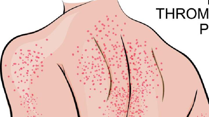 丘疹性荨麻疹有什么症状表现？