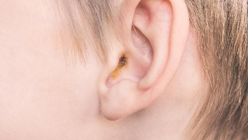 耳朵内长痘痘是怎么回事