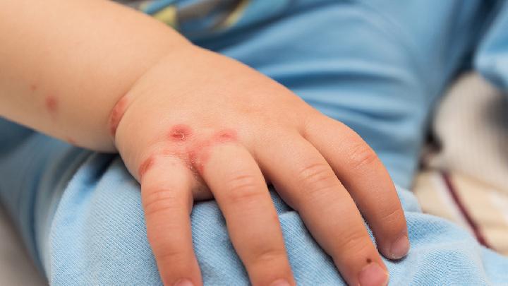 小儿湿疹有7种类型 早期分别有什么症状？