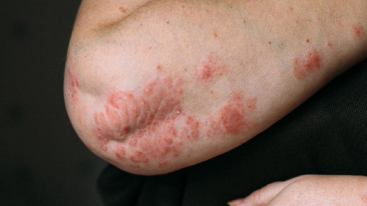 湿疹和痒疹的区别是什么？