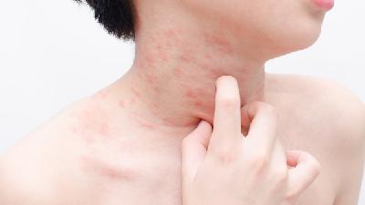 脸上长湿疹是什么原因 湿疹可以用盐水洗吗
