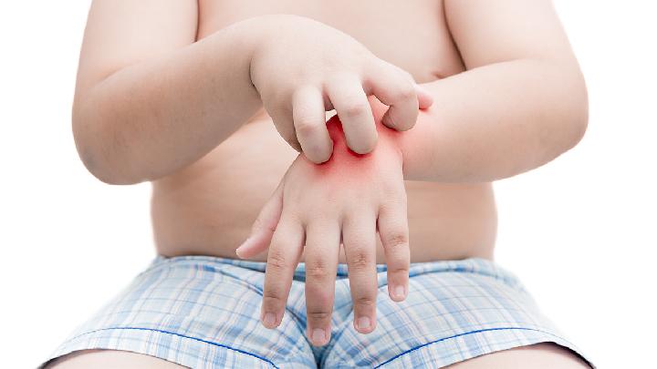 怎样治疗小儿荨麻疹？