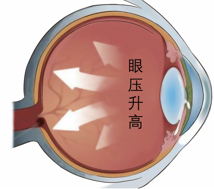 递法明益联用阿托品对近视综合症的治疗