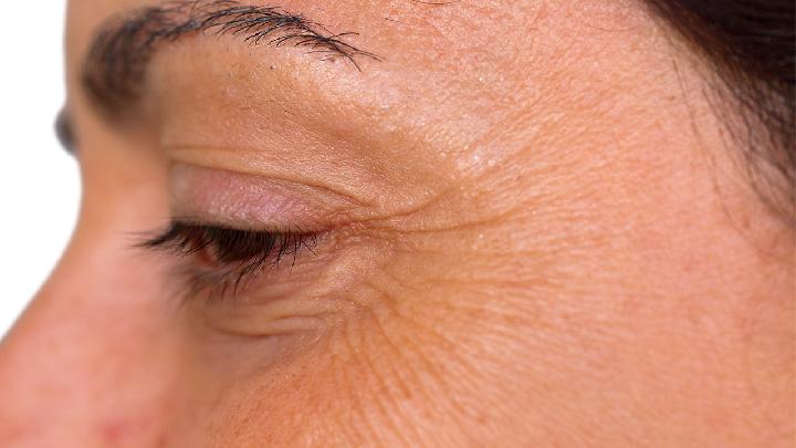 内眼角皱纹的治疗方法