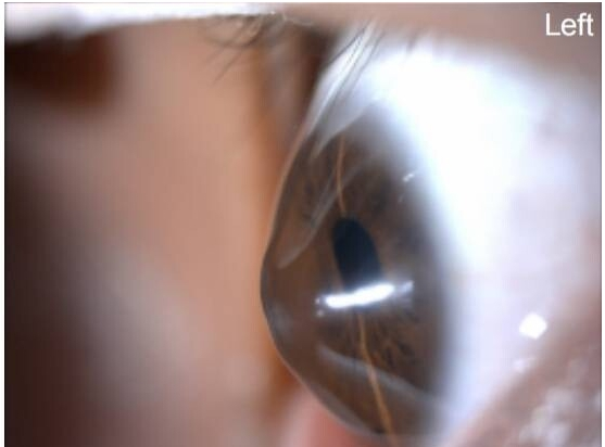 圆锥角膜——青少年视力“隐形杀手”，发现近视、散光急剧加深，请引起注意！