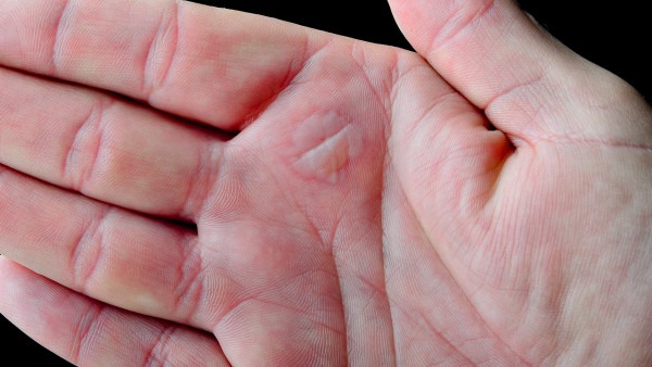 手掌发红是肝脏出现了问题严重吗？手掌潮红是什么病的征兆