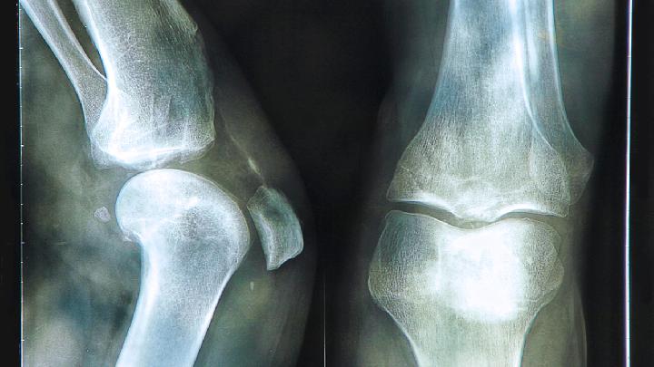 膝关节疼应该怎么按摩？