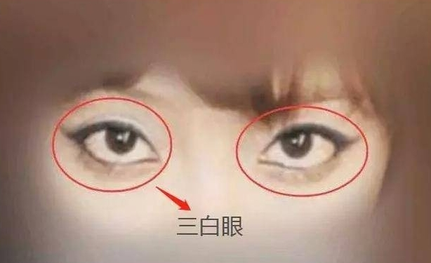 北京好年华五维锚定双眼皮：三白眼做双眼皮有没有影响？