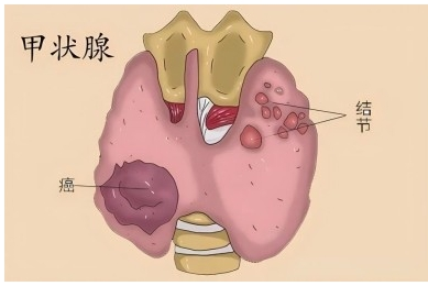 患甲状腺癌全切好还是半切好？米诺娃甲状外科朱精强教授说......