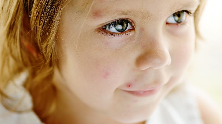 小孩慢性荨麻疹怎么办