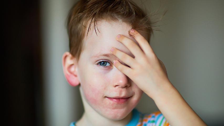 孩子急性荨麻疹怎么回事