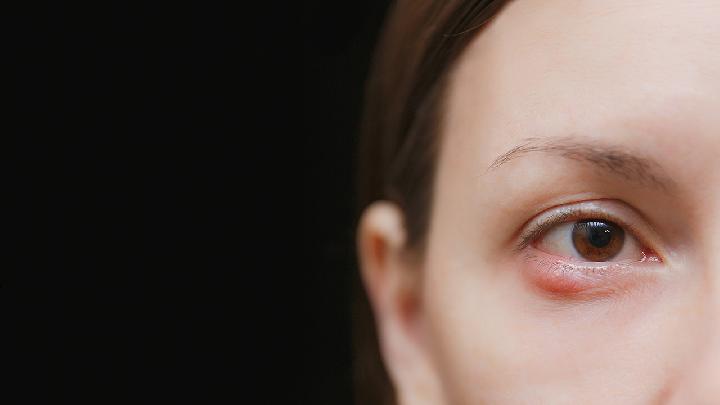 埋线双眼皮怎么消肿，教你快速消除眼部浮肿的方法