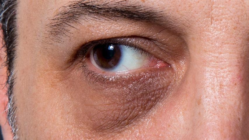 如何减轻黑眼圈 推荐两款食疗方