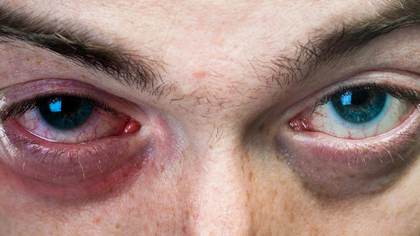 应该怎样预防青光眼？哪些不良行为会导致青光眼？[图]