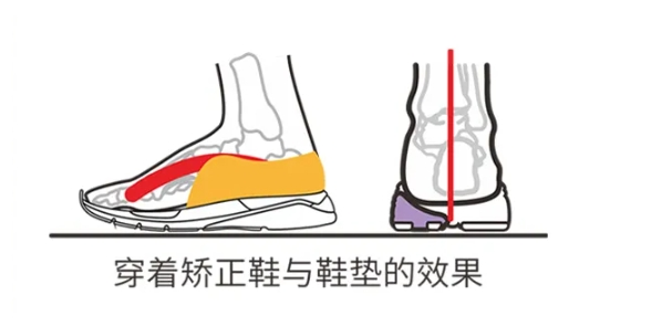 当足部问题遇上酷暑，矫正凉鞋为孩子送清凉