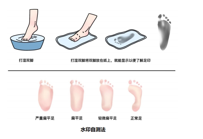 定期观察+及时定制矫正鞋垫干预，科学守护孩子每一步