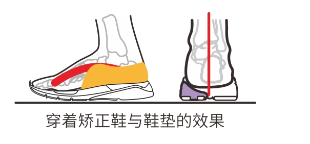 定期观察+及时定制矫正鞋垫干预，科学守护孩子每一步