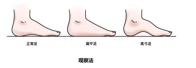 定期观察+及时定制矫正鞋垫干预，科学守护孩子每一步