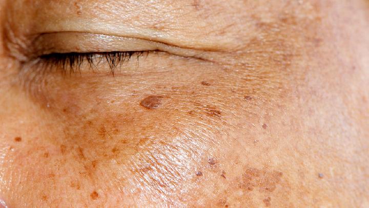 老年斑烦恼多？三招让你重获无暇肌肤！