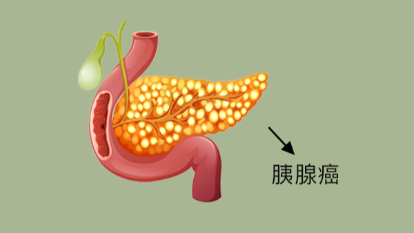 63岁男子胰腺癌离世，平时爱喝水不沾烟酒，医生叹气：这事害的