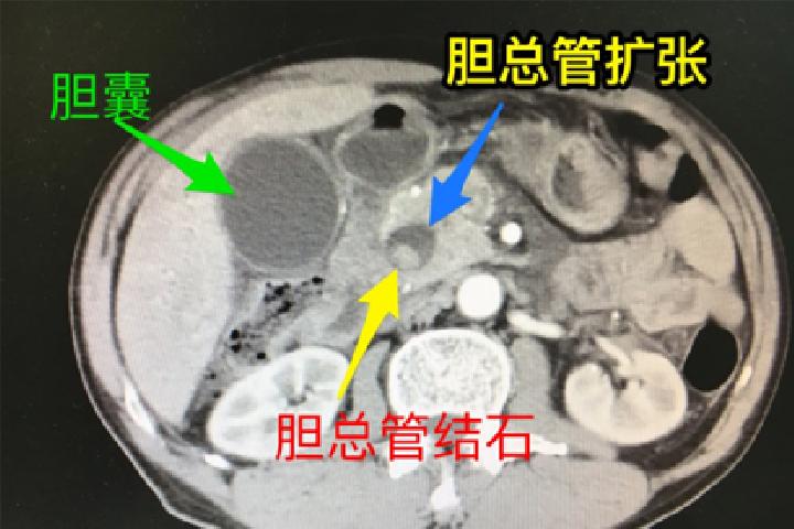 玻尿酸能维持多久