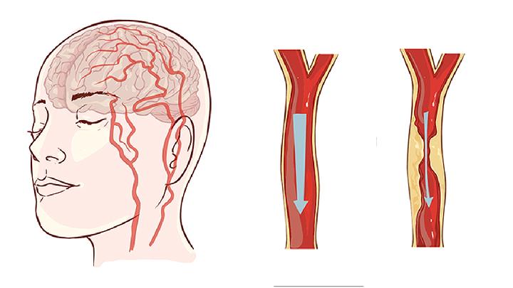 腦發(fā)育不良和腦癱有什么區(qū)別