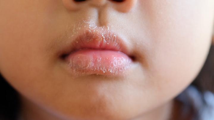 婴幼儿常见的8种疾病