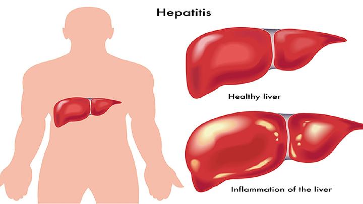 肝硬化右侧胸腔积液原因