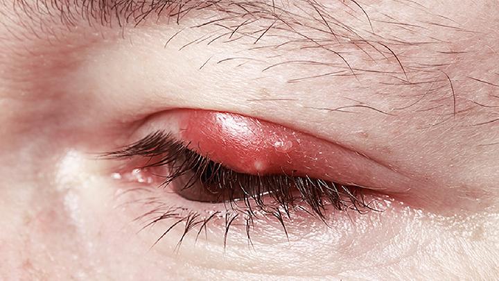 前庭大腺囊腫幾天可以消腫