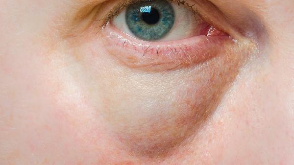 3分钟消除眼袋按摩法 电眼闪闪惹人爱