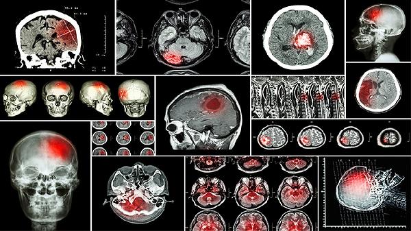 老人舌头起泡拖延2个月 查出舌癌割半个舌头