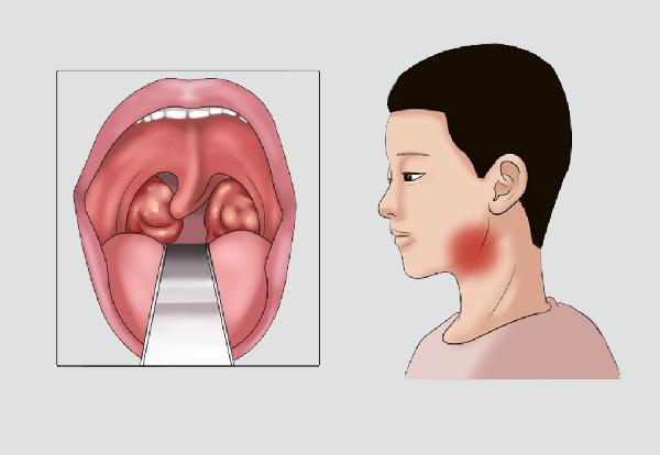 扁桃体腺炎的症状是什么