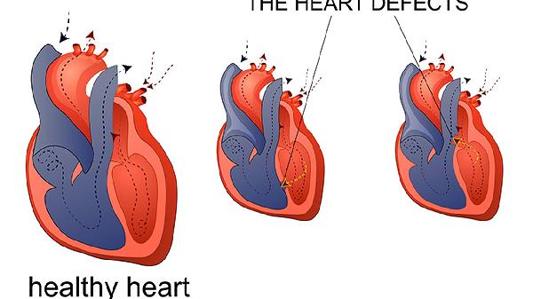 孩子心脏瓣膜关闭不全怎么办？